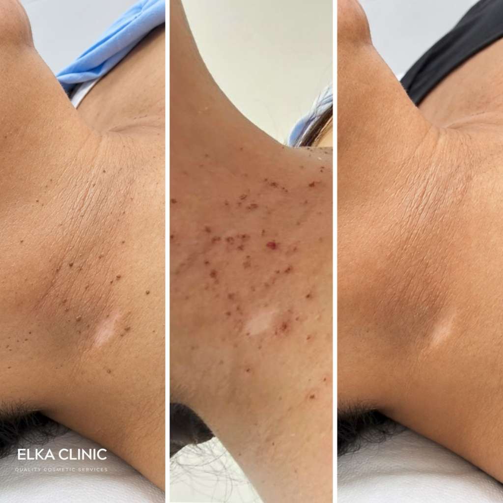 Before, immediately after and healed results of Plasma Pen skin tag removal on the neck at ELKA CLINIC Perth