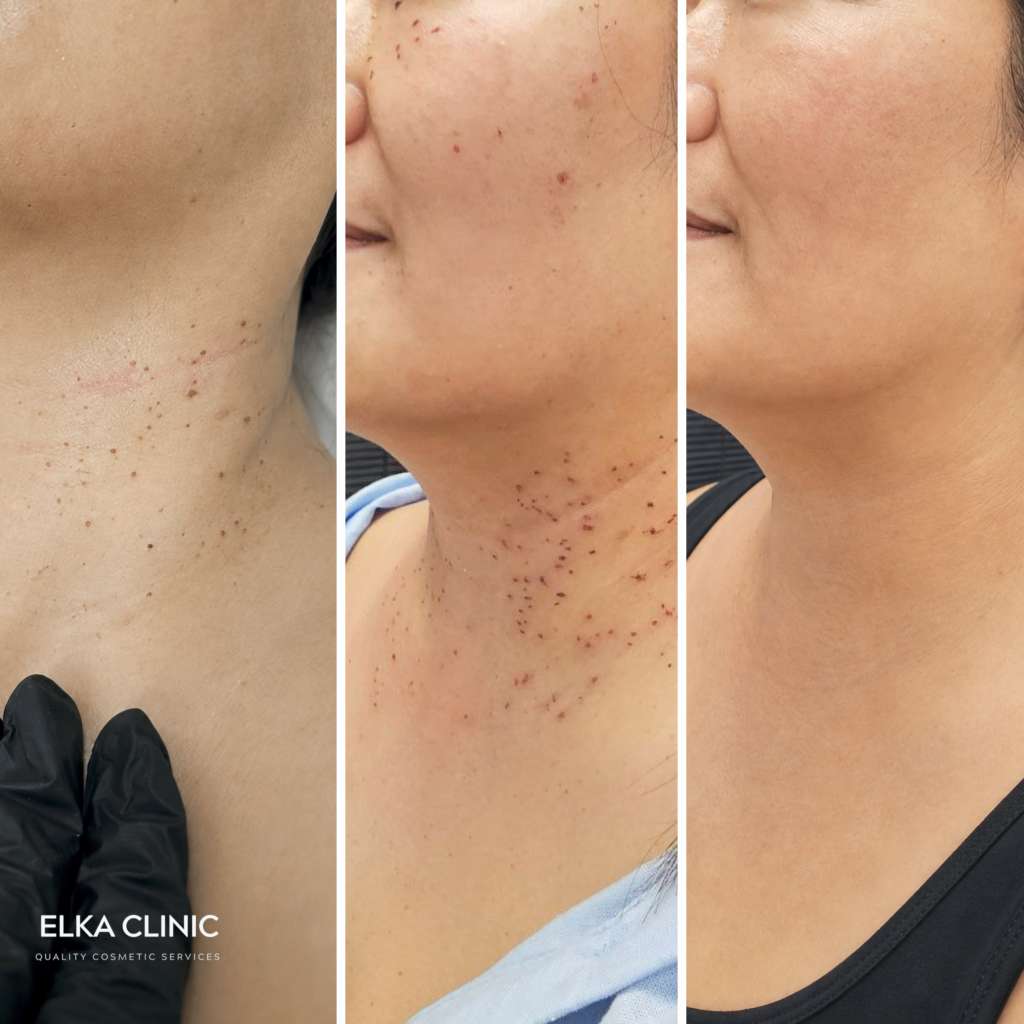 Before, immediately after and healed results of Plasma Pen skin tag removal on the neck at ELKA CLINIC Perth, second client