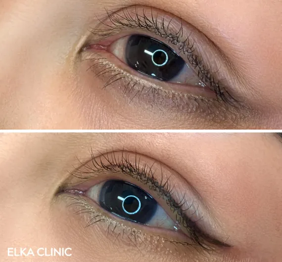 Before and after eyeliner tattoo at ELKA Clinic Perth