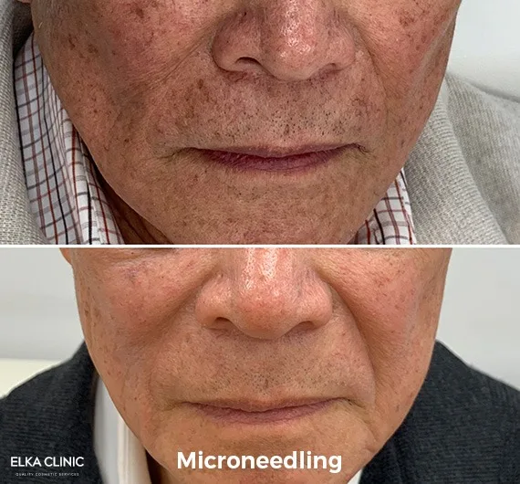 Before and after microneedling skin treatment at ELKA Clinic Perth