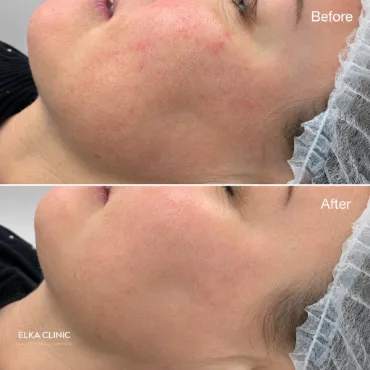 Skin before and after microneedling at ELKA Clinic Perth