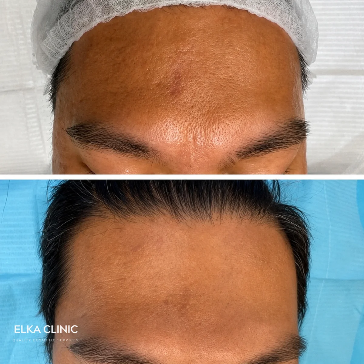 Enlarged forehead pores before and after microneedling at ELKA CLINIC Perth