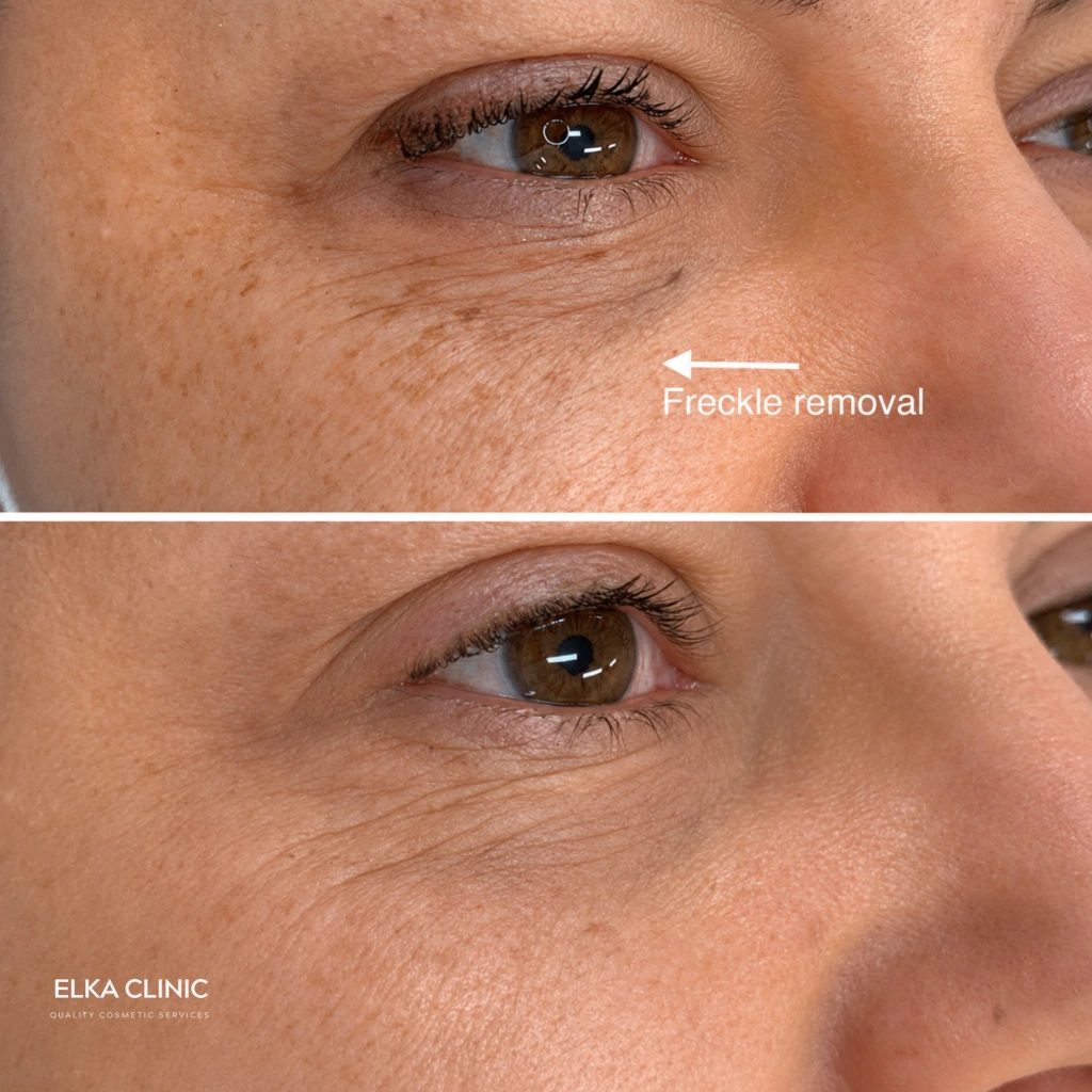Before and after photographs of freckle removal with Plasma Pen at ELKA CLINIC in Perth
