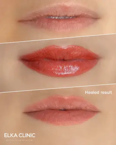 Lip blush tattoo before, immediately after and healed at ELKA CLINIC Perth
