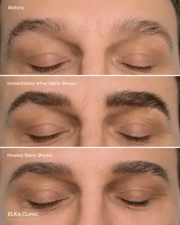 Men’s nano brows before and after a touch-up at ELKA CLINIC Perth