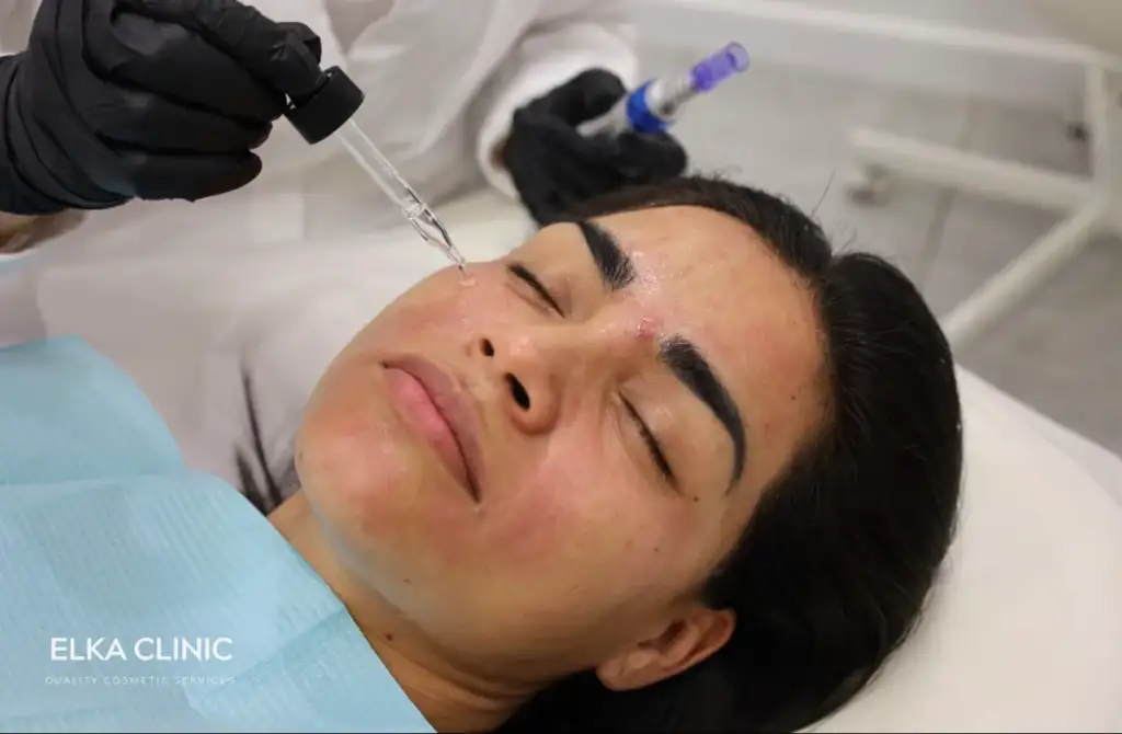 A client&rsquo;s skin flushed during a microneedling session at ELKA CLINIC in Subiaco, Perth, while the therapist works across the cheek