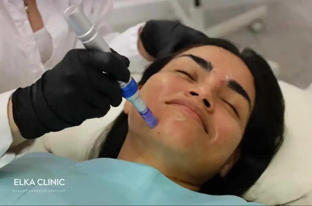 A microneedling session in progress at ELKA CLINIC in Subiaco, Perth, with the therapist treating the cheek and jawline