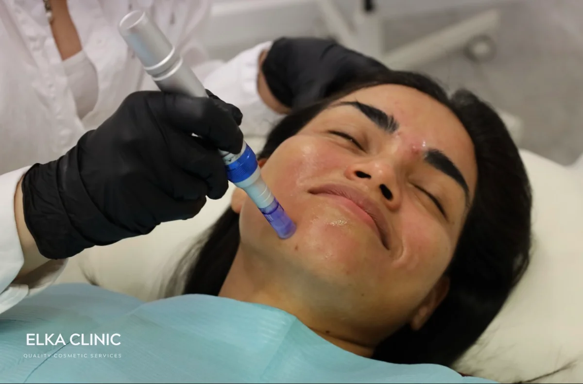 Microneedling treatment in progress at ELKA CLINIC in Subiaco, Perth