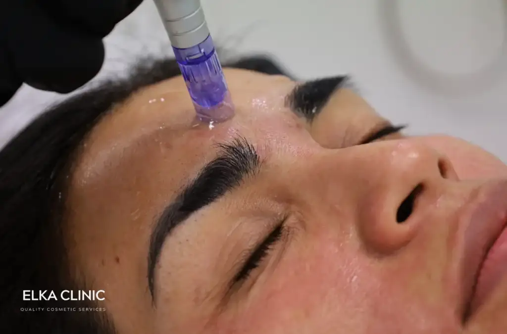 Close-up of a microneedling pen being used on a client&rsquo;s forehead during a treatment at ELKA CLINIC in Subiaco, Perth