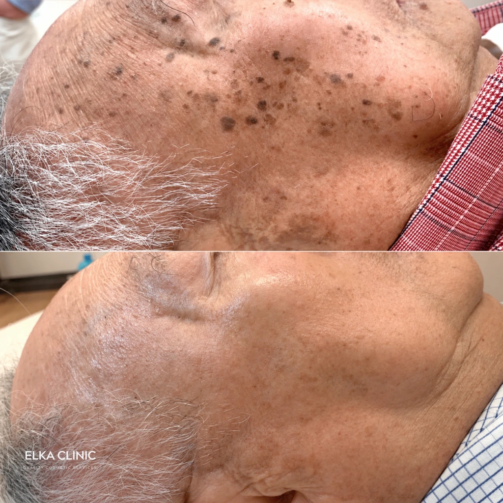 Before and after photographs of multiple benign skin lesion removal with Plasma Pen at ELKA CLINIC in Perth