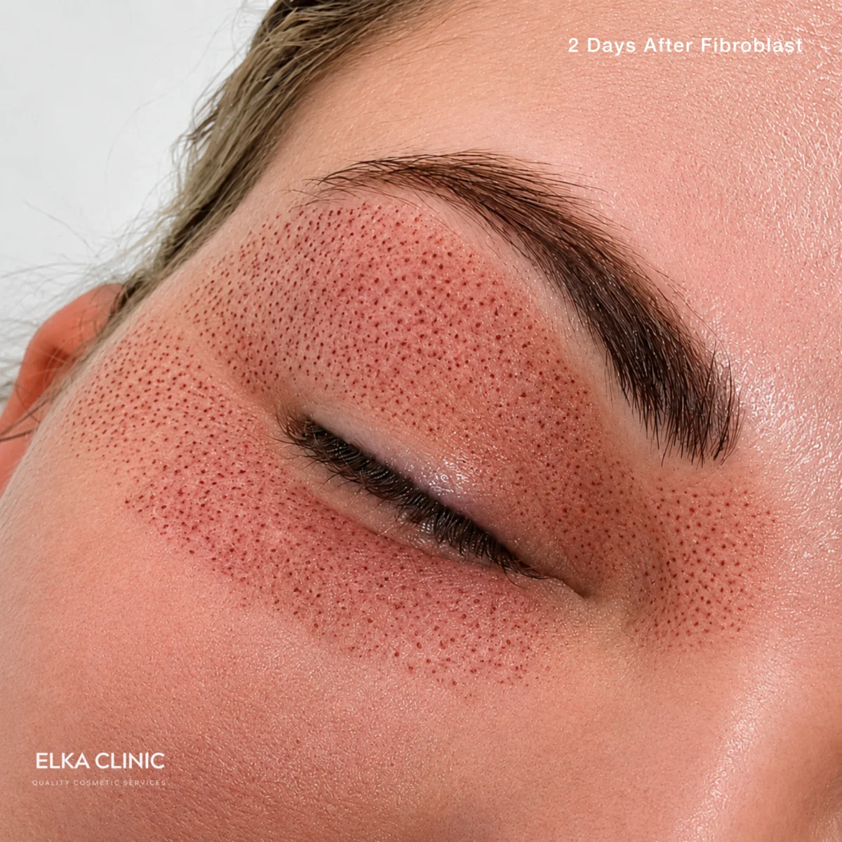Close-up of small carbon crusts across the upper eyelid, brow and temple two days after Plasma Pen fibroblast treatment at ELKA CLINIC in Perth