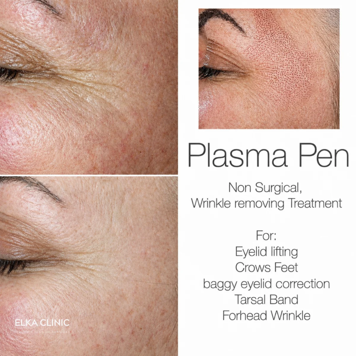 Crow’s feet before Plasma Pen fibroblast treatment, immediately after with fine carbon crusts, and after healing, at ELKA CLINIC in Perth