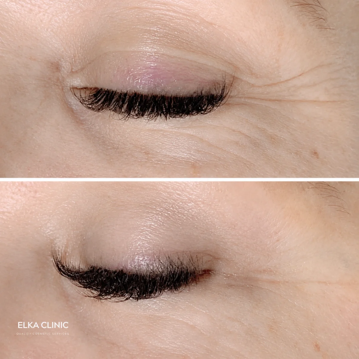 Upper eyelid and outer corner lines before Plasma Pen fibroblast treatment and again once healed, at ELKA CLINIC in Perth