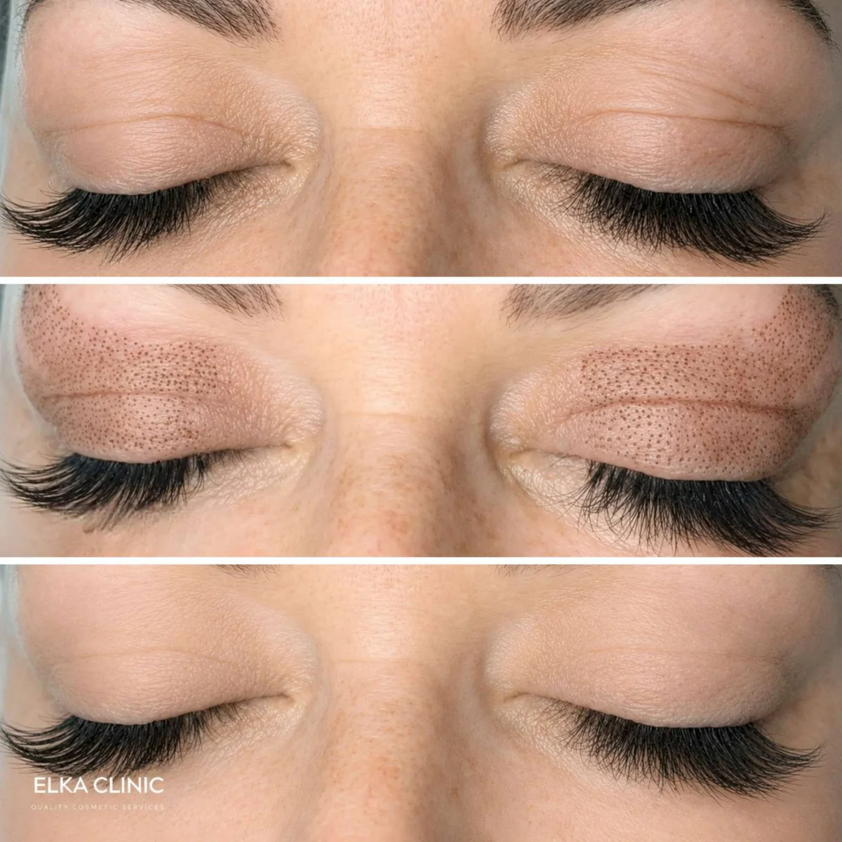 Both upper eyelids before Plasma Pen fibroblast treatment, immediately after with carbon crusts across the lid, and once healed, at ELKA CLINIC in Perth