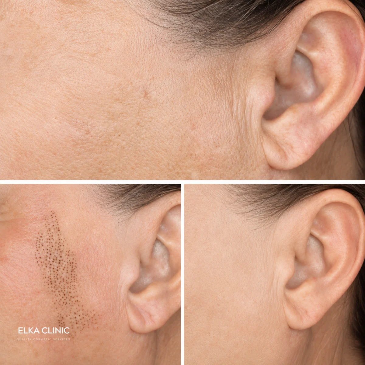 Fine lines on the temple and cheek before Plasma Pen fibroblast treatment, immediately after with carbon crusts, and once healed, at ELKA CLINIC in Perth