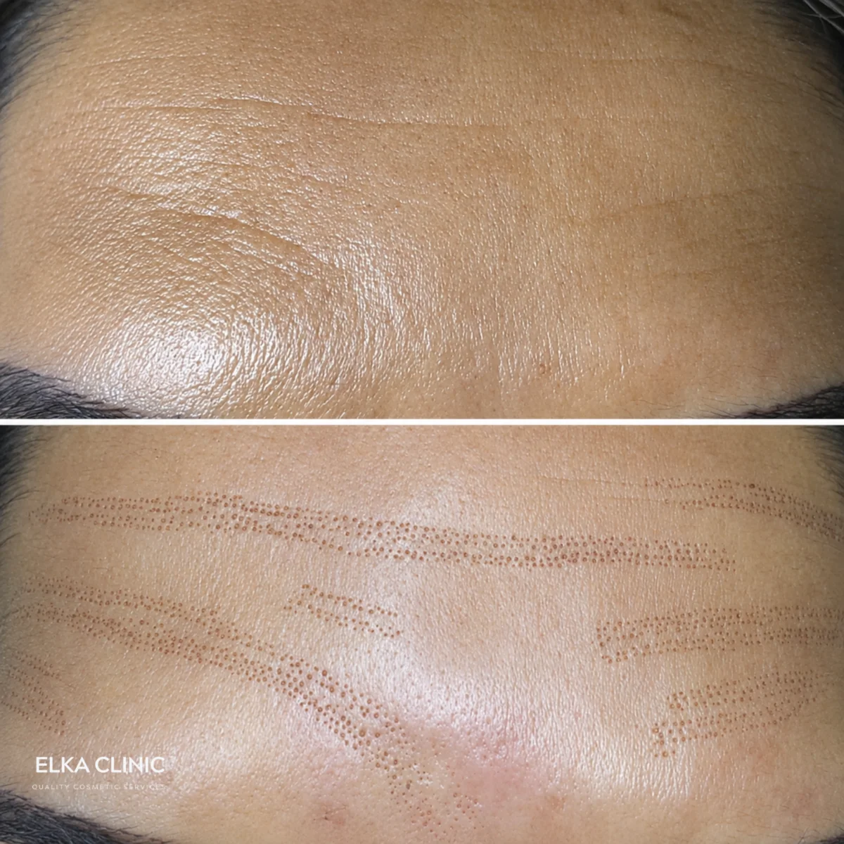 Forehead wrinkles before Plasma Pen fibroblast treatment and immediately afterwards, with rows of small carbon crusts following each line, at ELKA CLINIC in Perth