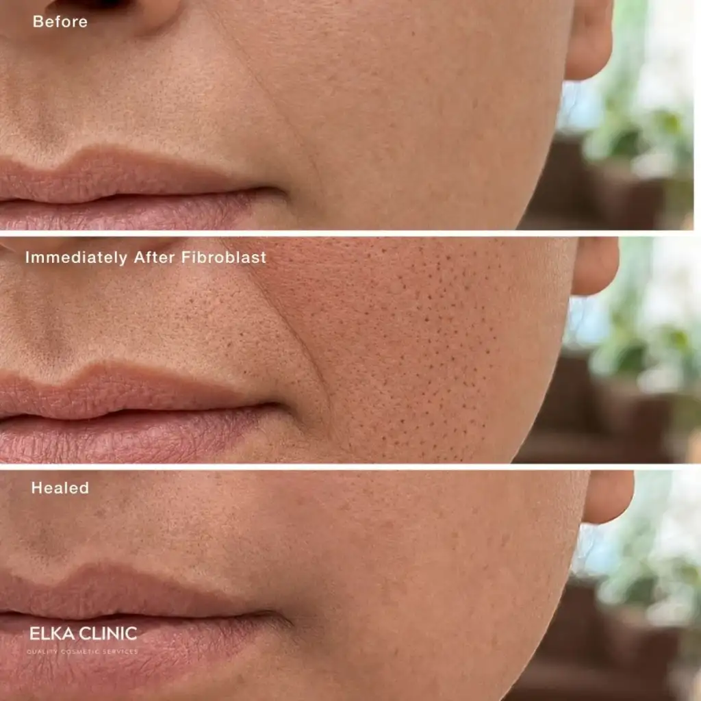 Nasolabial fold lines before, immediately after and healed following plasma pen fibroblast at ELKA CLINIC Perth