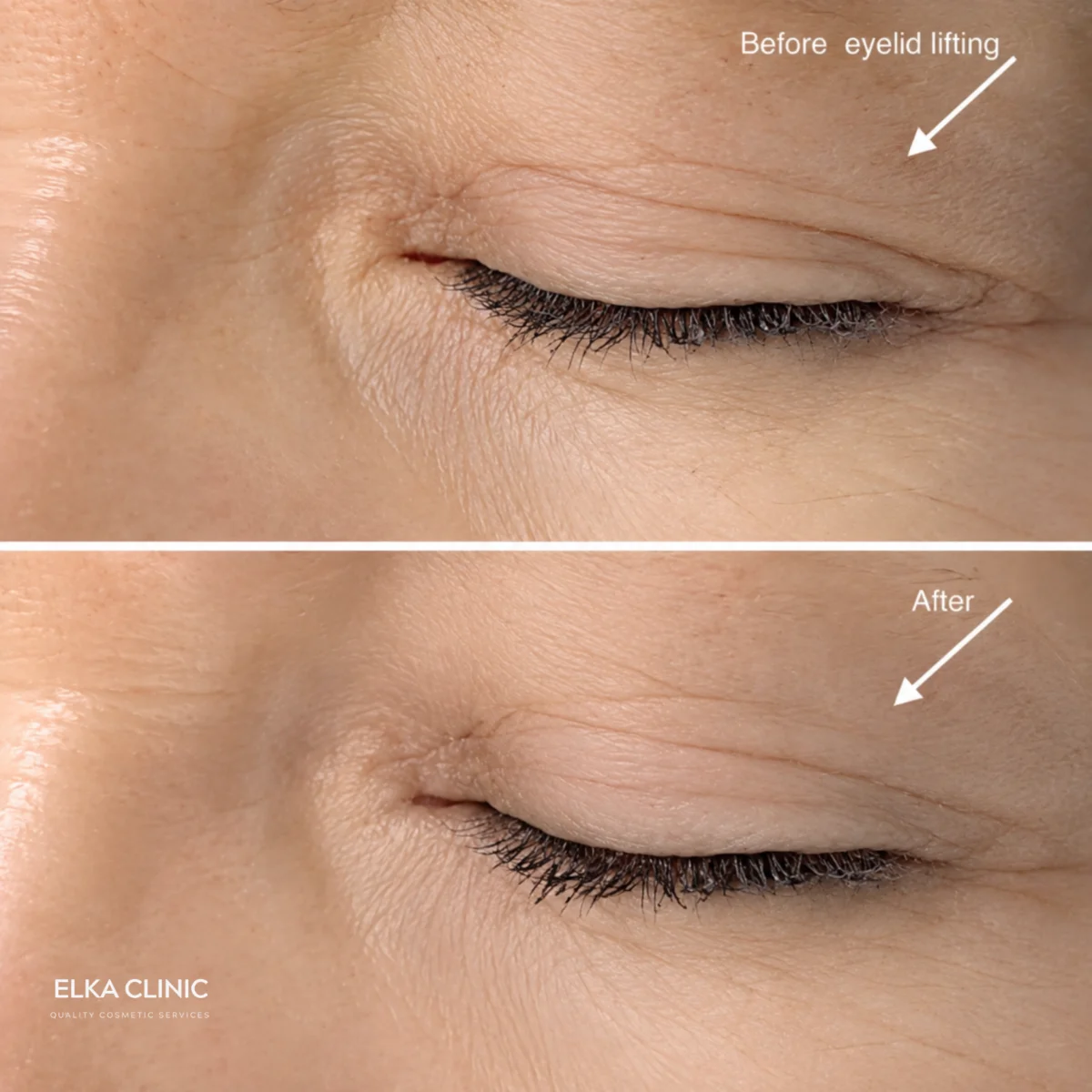 Upper eyelid on mature skin before Plasma Pen fibroblast treatment and after healing, at ELKA CLINIC in Perth