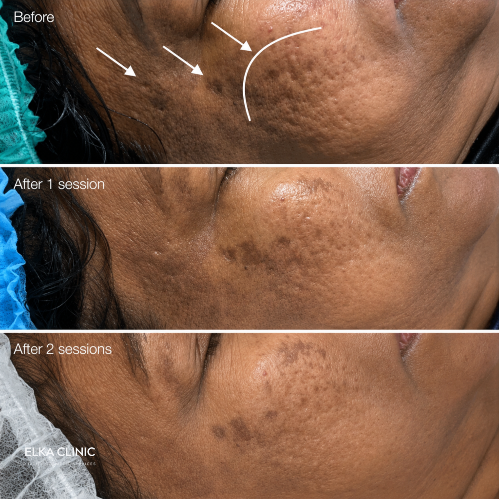 Before and after photographs of acne scarring on a client’s cheek, taken at ELKA CLINIC in Perth