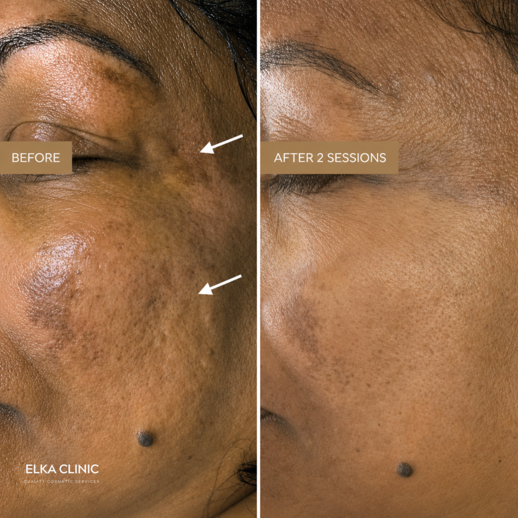 Before and after photographs of indented acne scarring and skin texture, taken at ELKA CLINIC in Perth