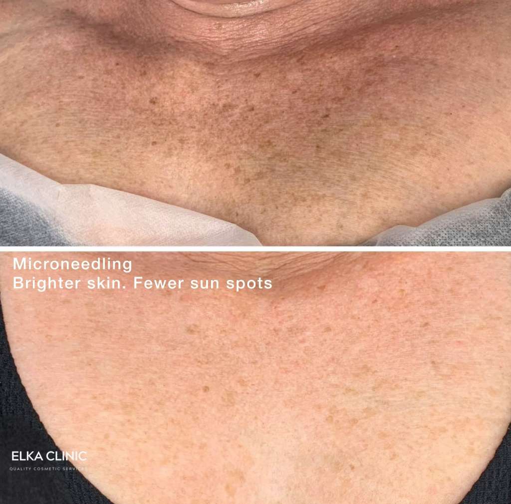 Before and after photographs of freckles on a client’s décolletage, taken at ELKA CLINIC in Perth