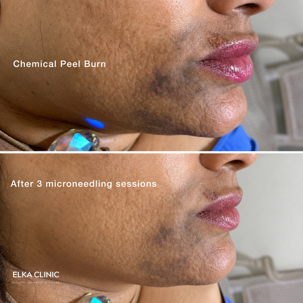 Before and after photographs of pigmentation following a chemical peel on a client’s skin, taken at ELKA CLINIC in Perth
