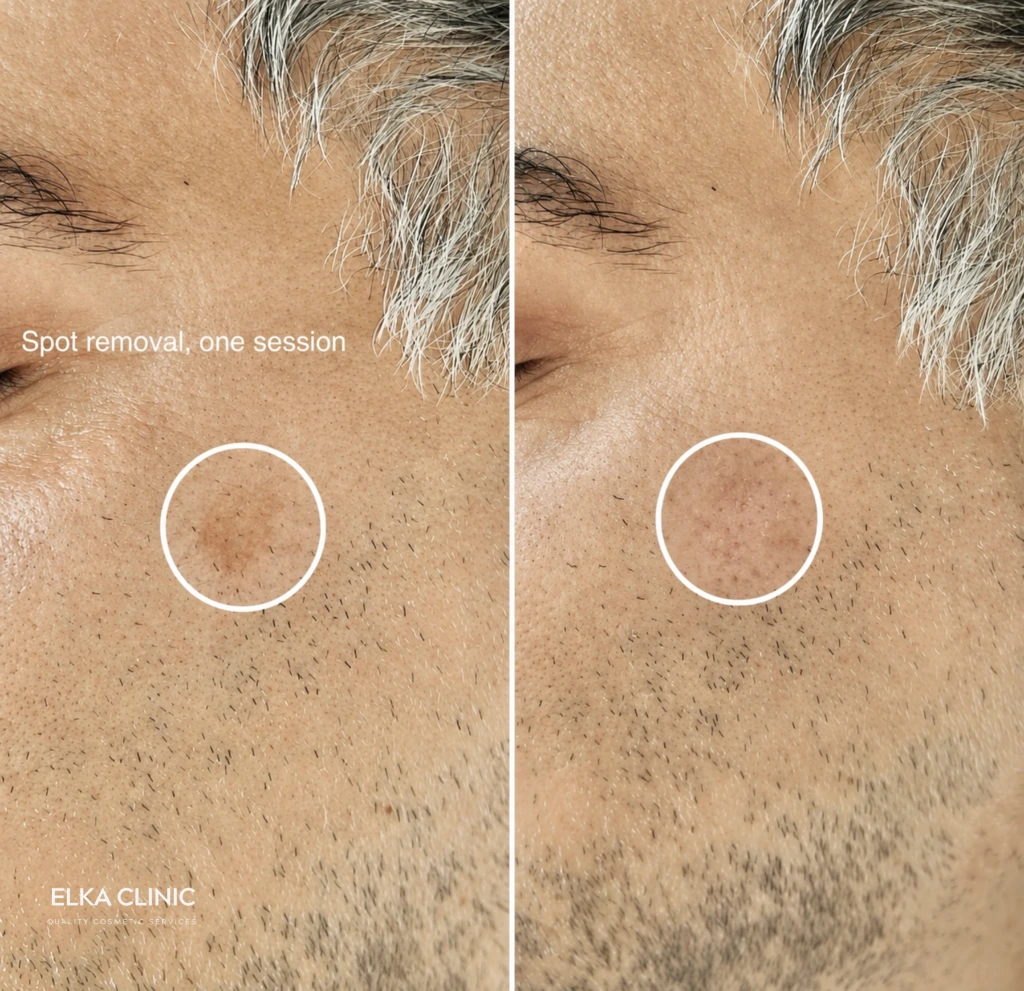 Before and after photographs of sun spot removal with Plasma Pen at ELKA CLINIC in Perth, with the treated area circled