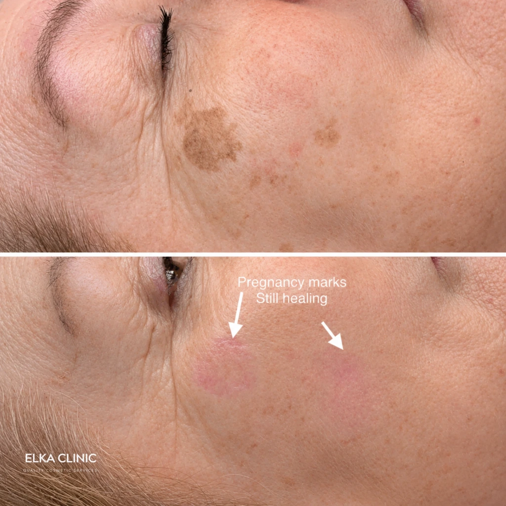 Before and after photographs of sun spot removal with Plasma Pen at ELKA CLINIC in Perth