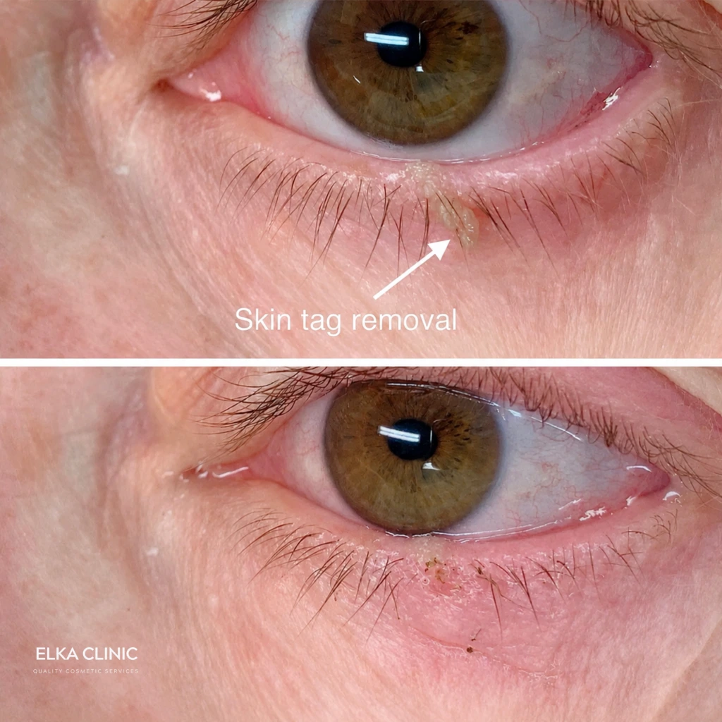 Before and after photographs of benign skin lesion removal near the eyes with Plasma Pen at ELKA CLINIC in Perth (photograph two of two)