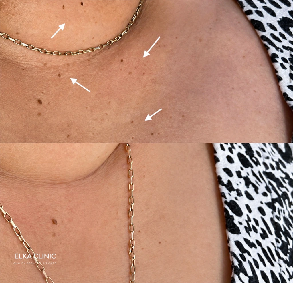 Before and after photographs of skin tag removal with Plasma Pen at ELKA CLINIC in Perth