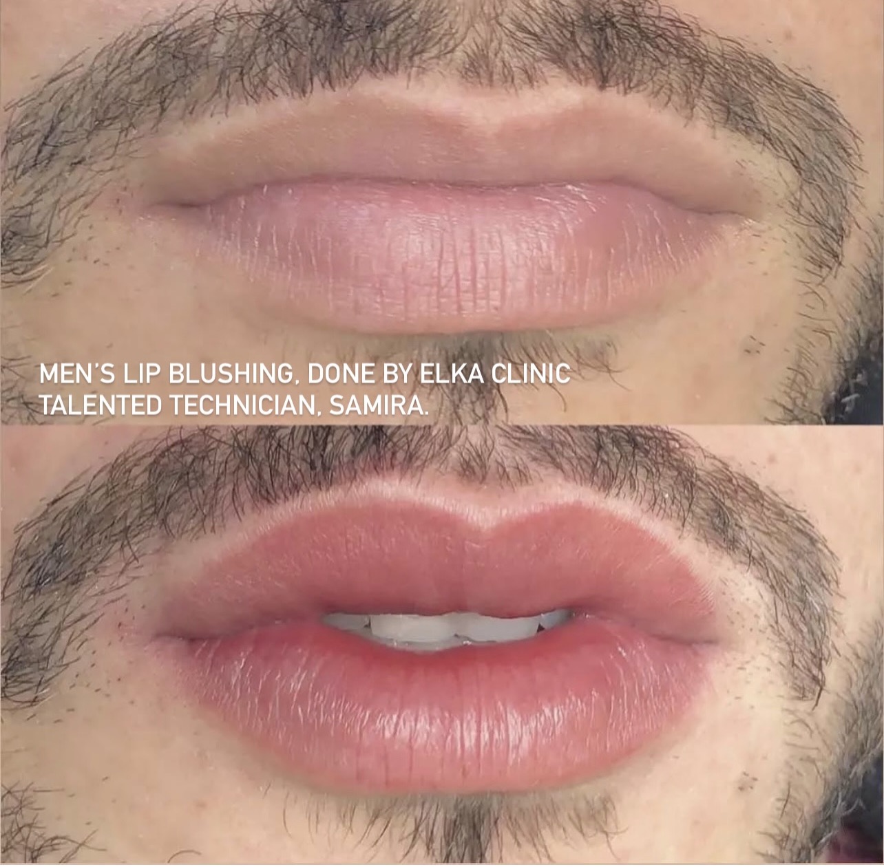 Men’s lip blush comparison showing the immediate treatment result by Samira at ELKA CLINIC Perth