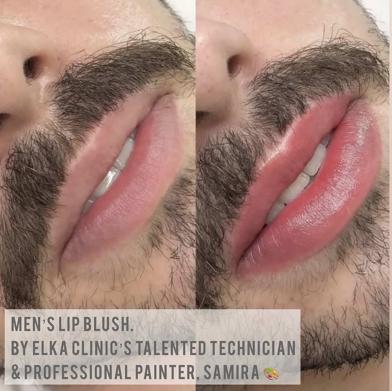 Angled men’s lip blush comparison showing the immediate result by Samira at ELKA CLINIC Perth