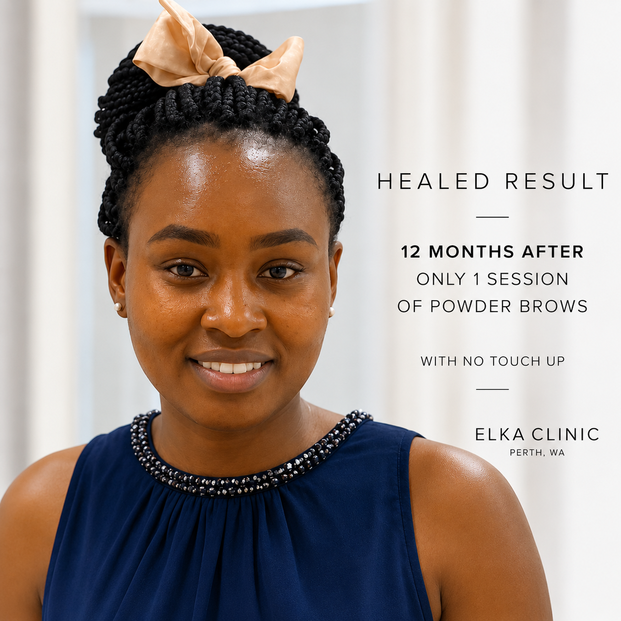 Healed powder brows on tan skin, 12 months after one session with no touch-up, by ELKA CLINIC