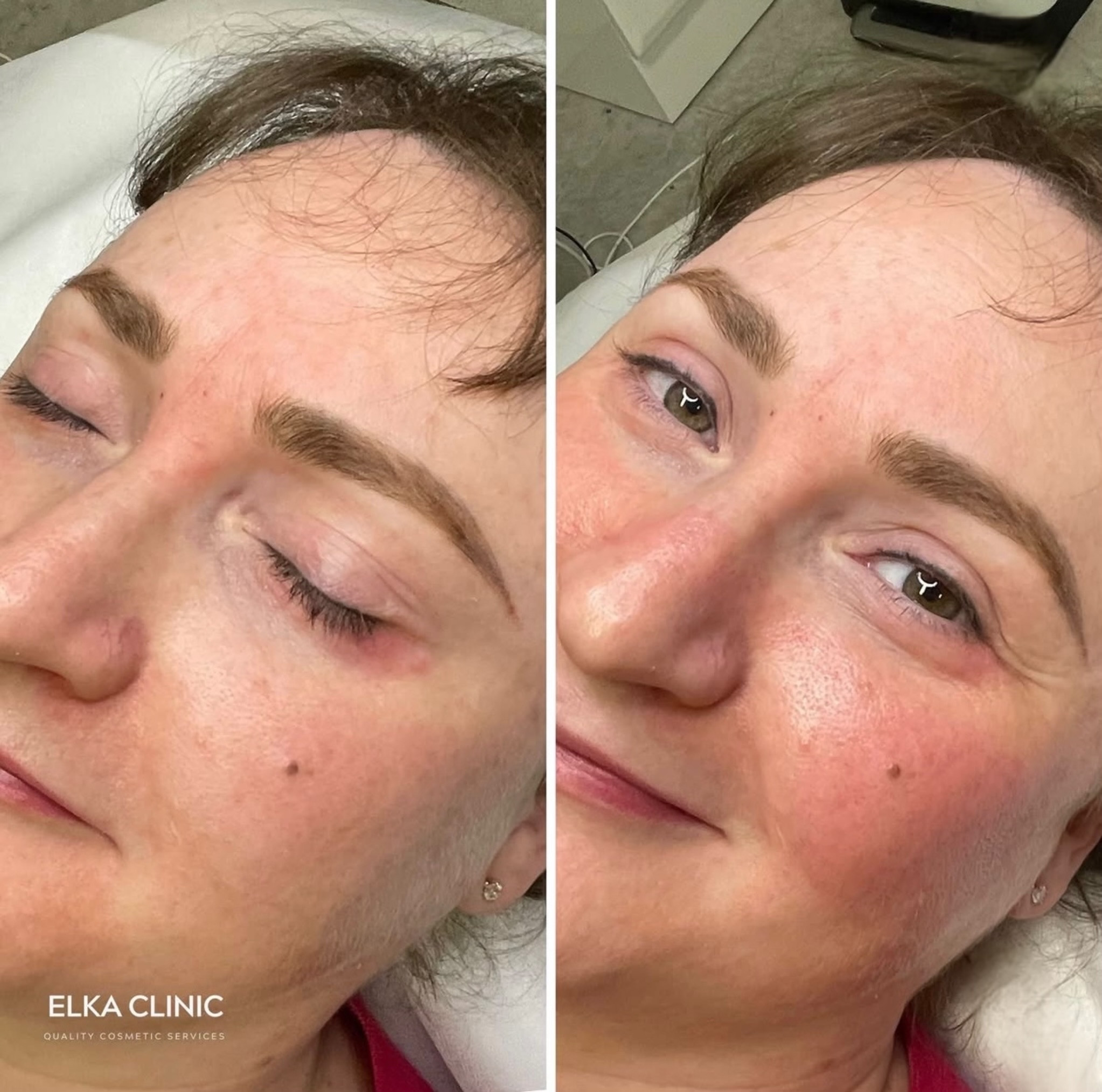 Cheek Blush at ELKA CLINIC, original two-panel client photo
